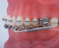 Herbst and Forsus Appliances - american canyon orthodontics